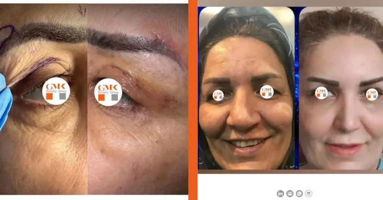 قیمت بلفاروپلاستی