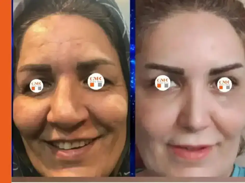 بلفاروپلاستی