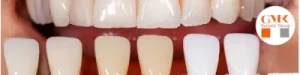 لاک دندان برای سفیدی